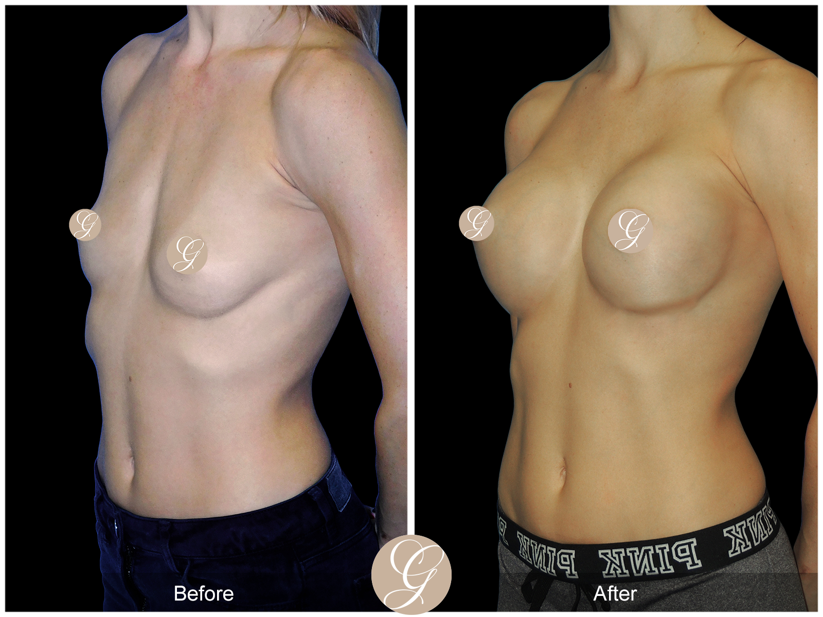 Breast Augmentation PT5 Image