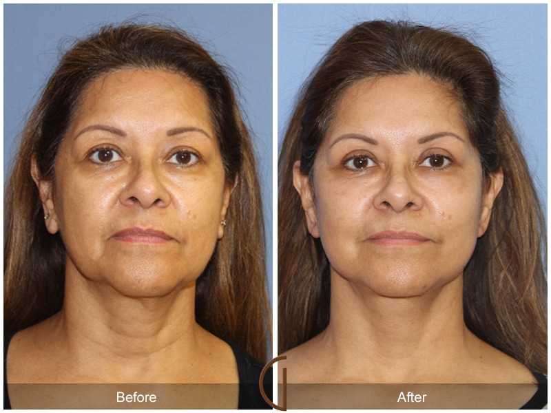 Eyelid Surgery North Tustin CA 13 Image