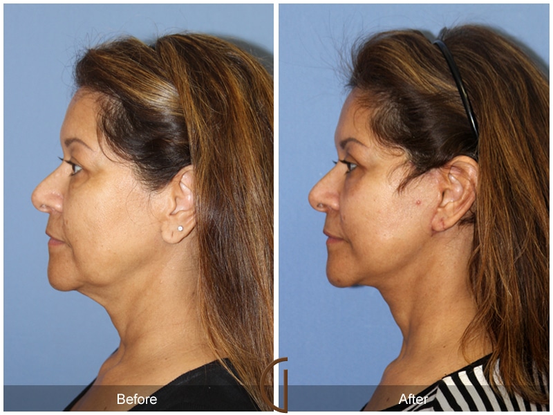 Eyelid Surgery North Tustin CA 13 Image