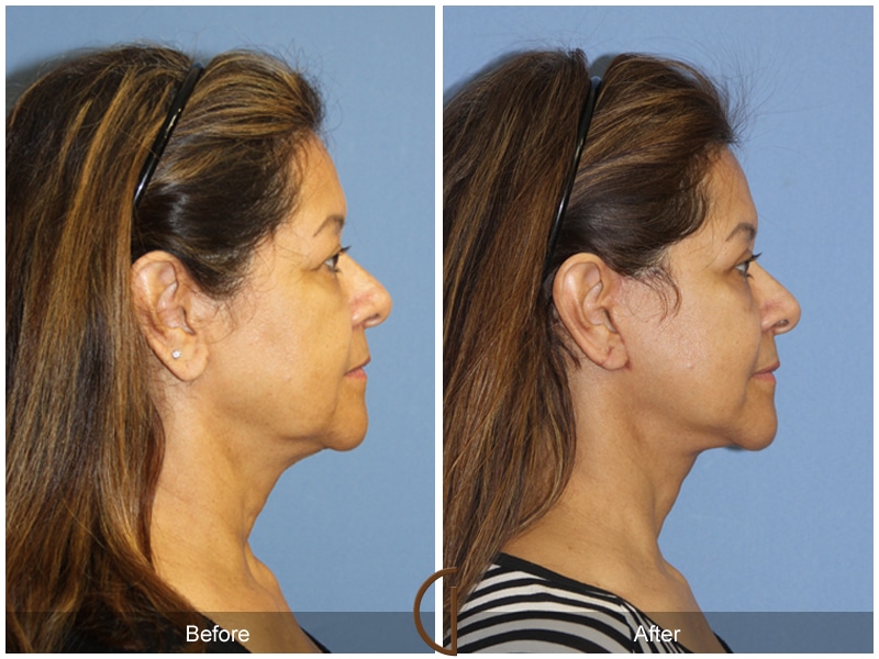 Eyelid Surgery North Tustin CA 13 Image