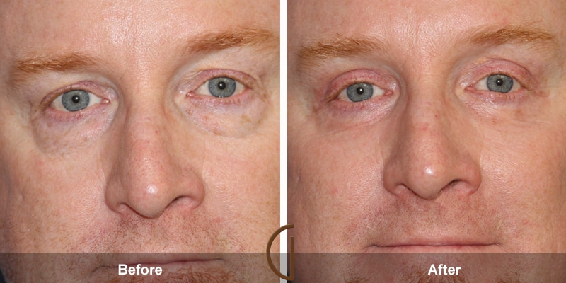 Eyelid Surgery Las Flores CA 14 Image