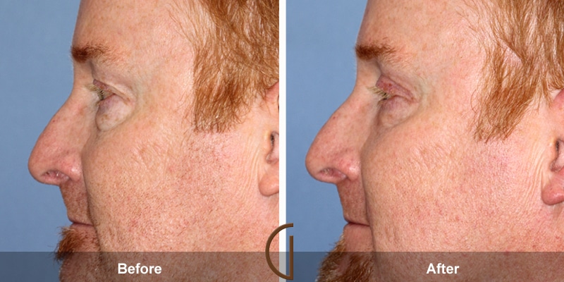 Eyelid Surgery Las Flores CA 14 Image