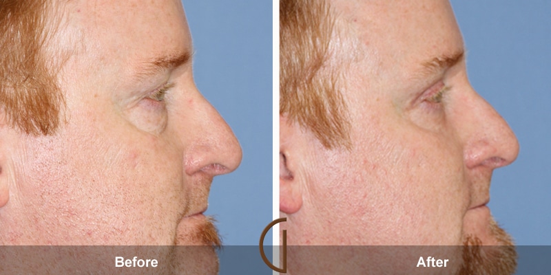 Eyelid Surgery Las Flores CA 14 Image