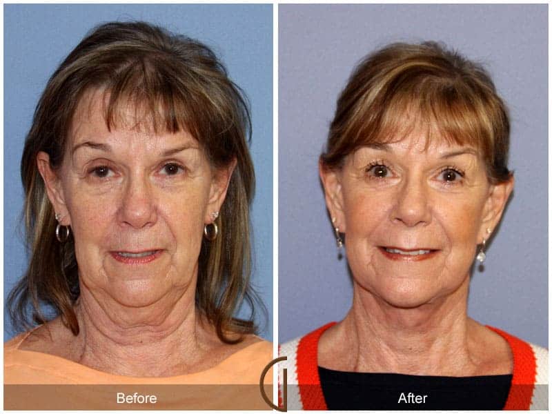 Facelift La Palma CA 1 Image