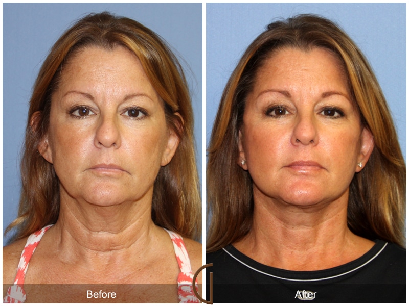 Facelift Tustin CA 124 Image
