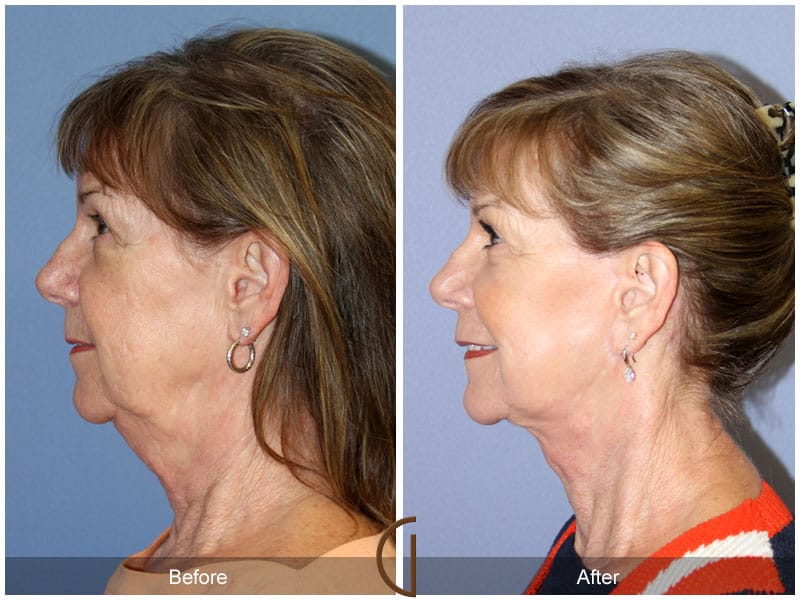 Facelift La Palma CA 1 Image