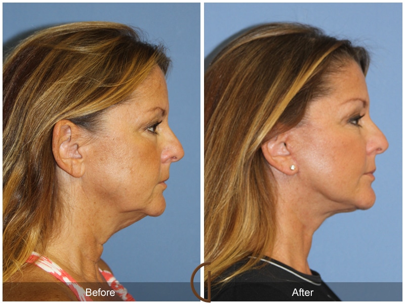Facelift Tustin CA 124 Image