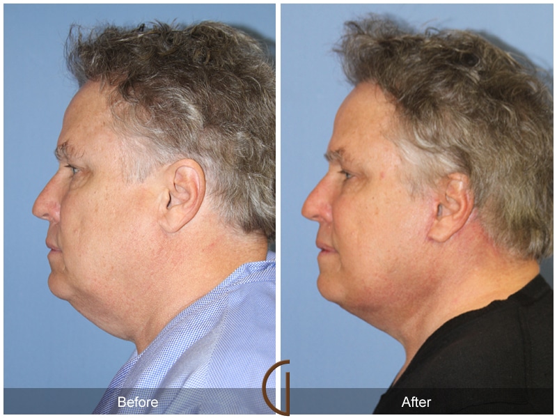 Facelift Buena Park CA Image