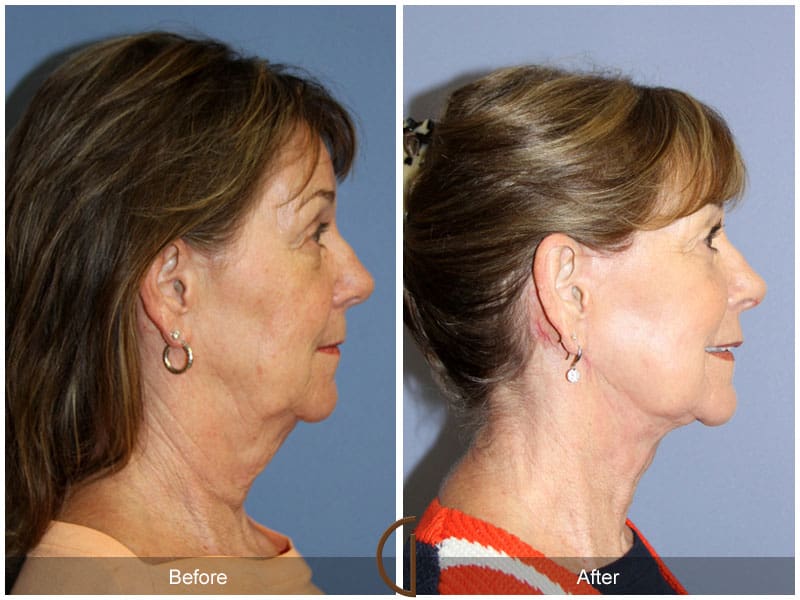 Facelift La Palma CA 1 Image