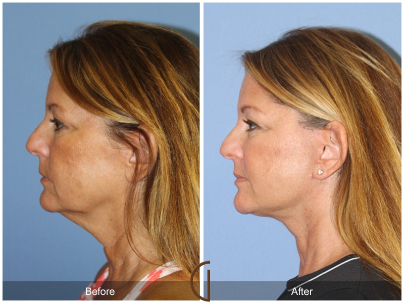 Facelift Tustin CA 124 Image