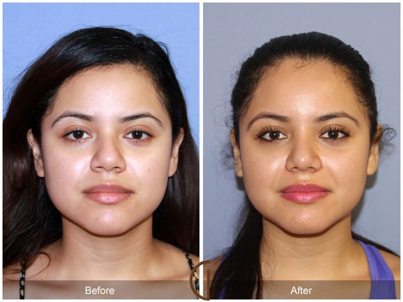 Rhinoplasty Nose Surgery Carlsbad CA 1 Image