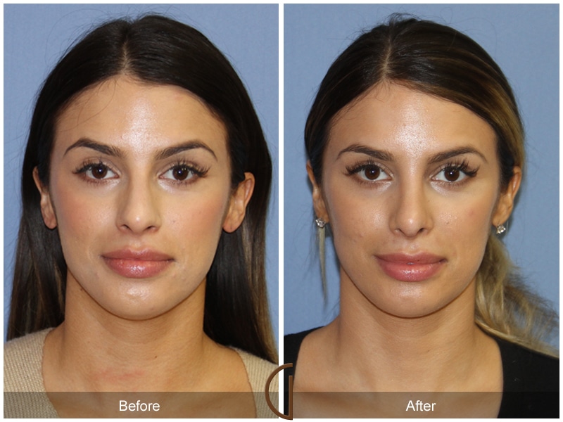 Rhinoplasty Nose Surgery Bonita CA 87 Image