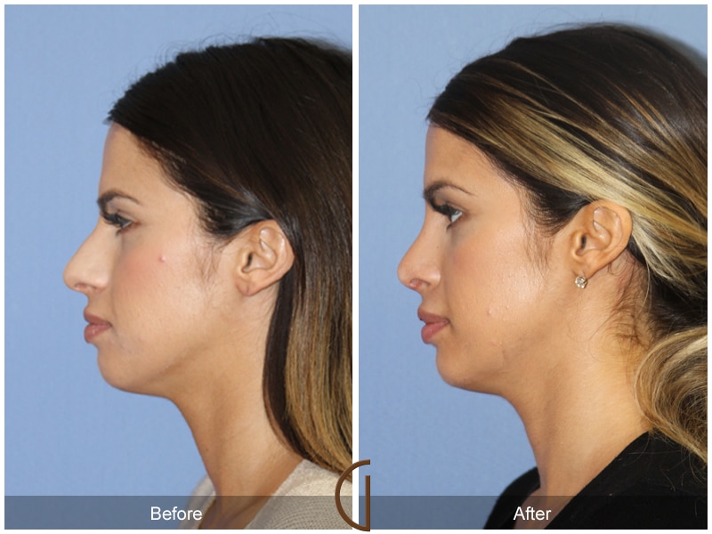 Rhinoplasty Nose Surgery Bonita CA 87 Image