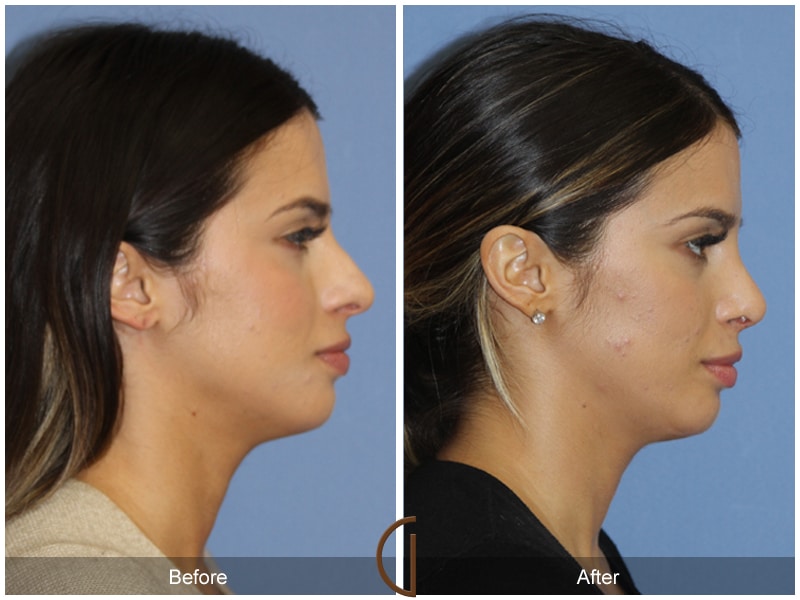 Rhinoplasty Nose Surgery Bonita CA 87 Image