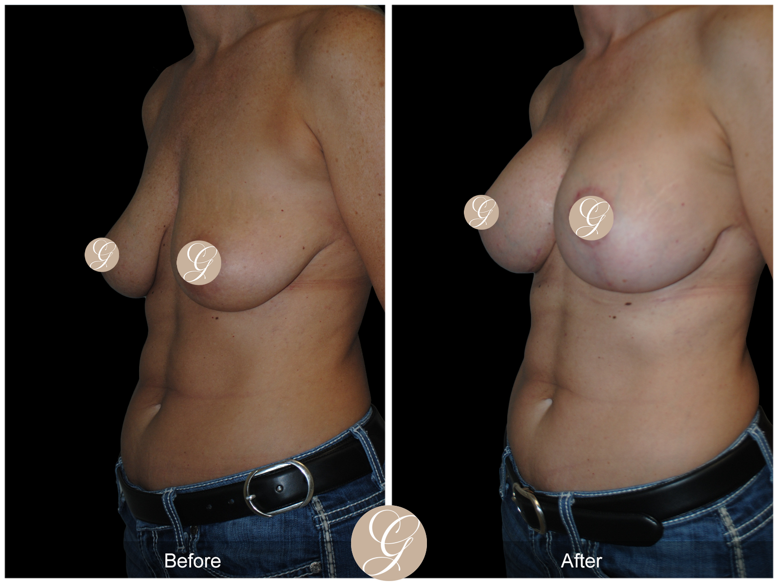 Breast Augmentation Lift (Mastopexy) Image