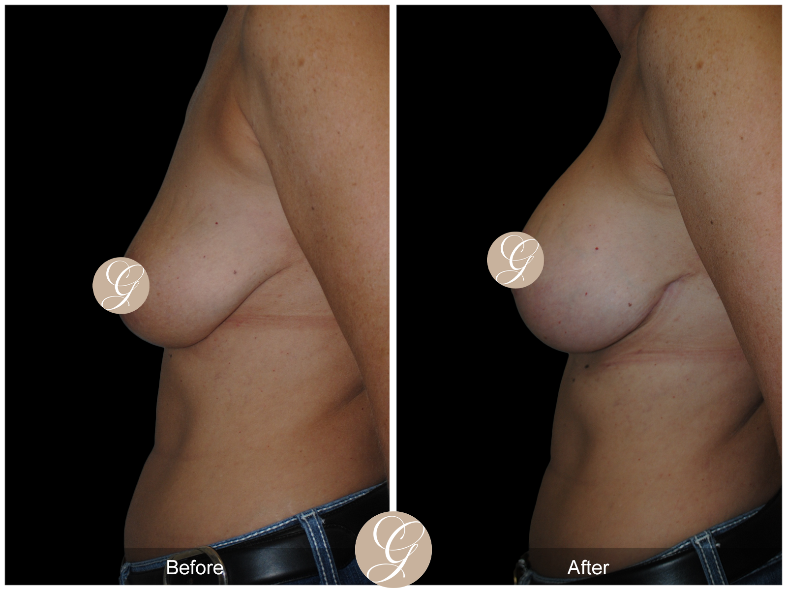 Breast Augmentation Lift (Mastopexy) Image