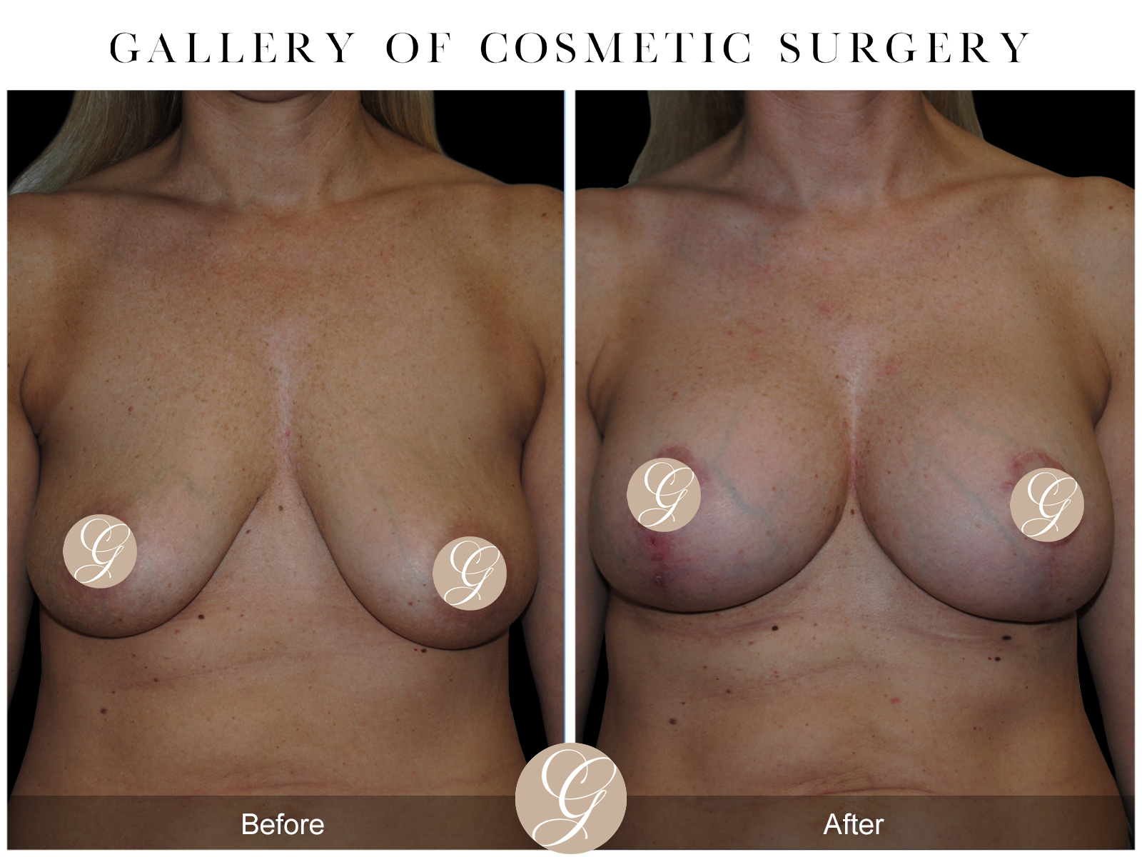 Breast Augmentation Lift (Mastopexy) Image