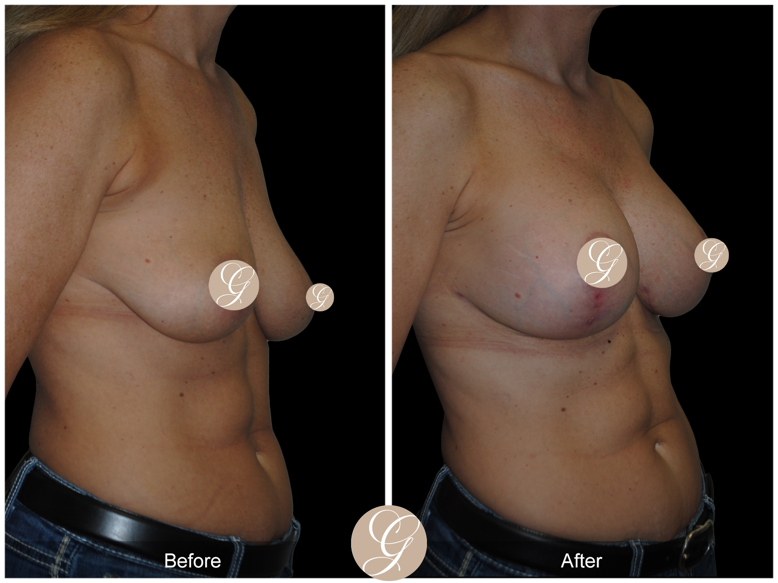 Breast Augmentation Lift (Mastopexy) Image
