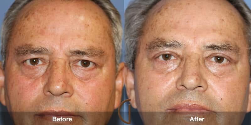 Eyelid Surgery Orange County 35 Image