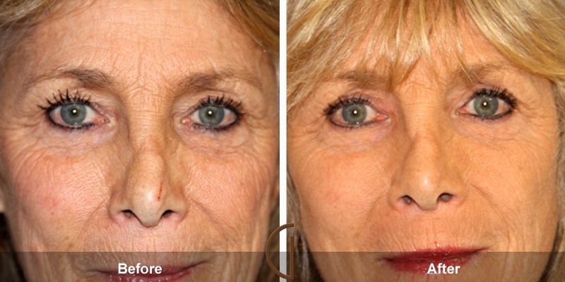 Eyelid Surgery Rossmoor CA 20 Image