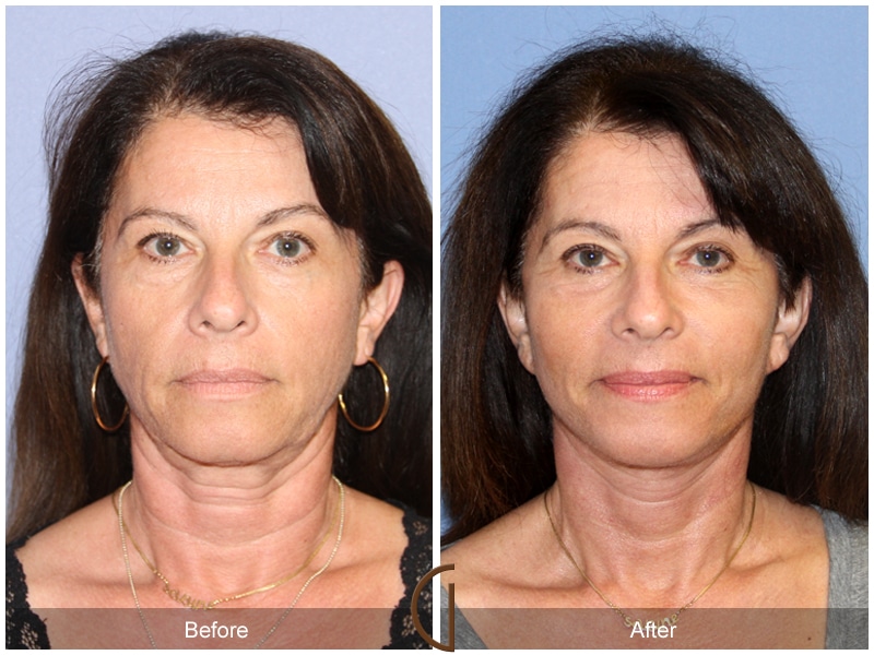 Eyelid Surgery Newport Beach CA 21 Image