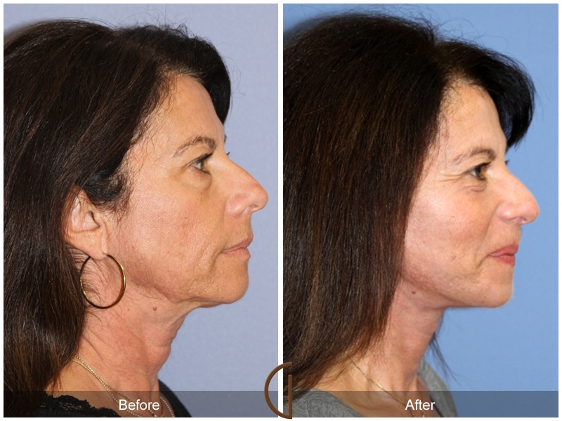 Eyelid Surgery Newport Beach CA 21 Image