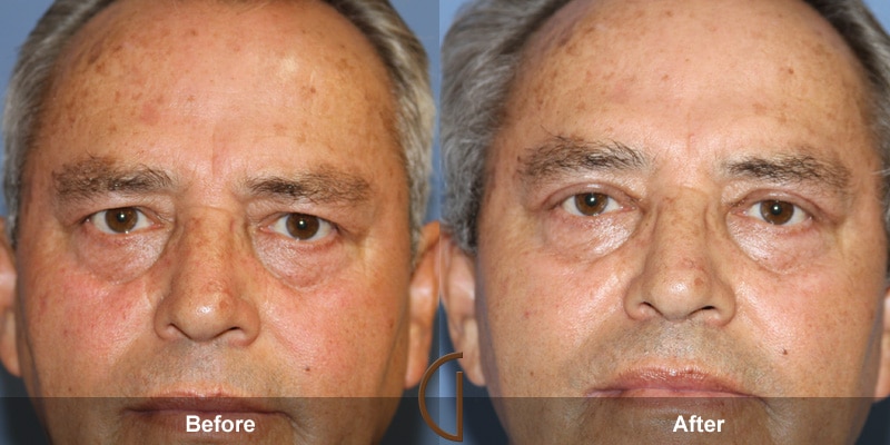 Eyelid Surgery Rancho Santa Margarita CA 22 Image
