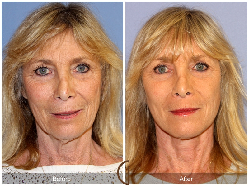 Eyelid Surgery Aliso Viejo CA 23 Image