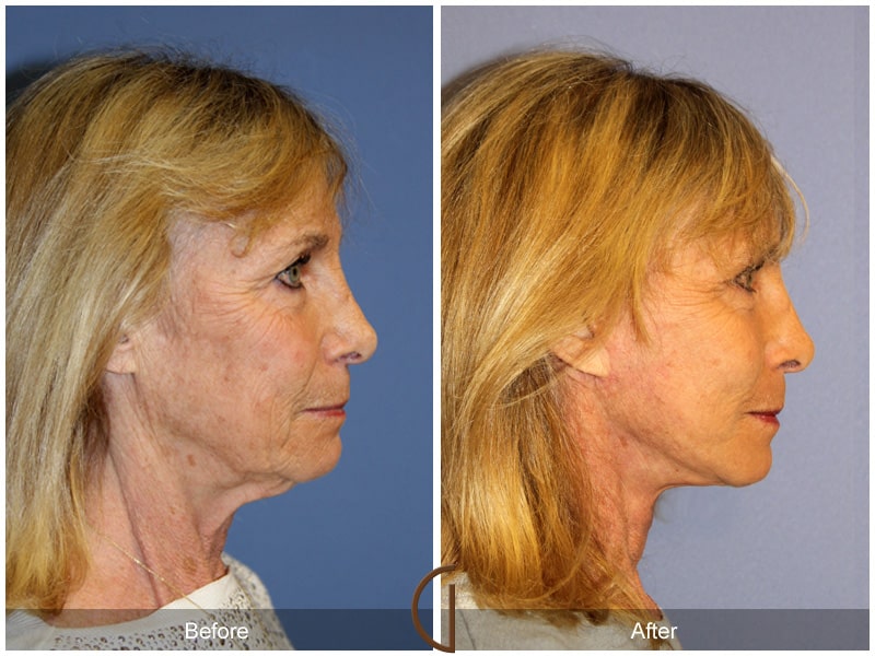 Eyelid Surgery Aliso Viejo CA 23 Image