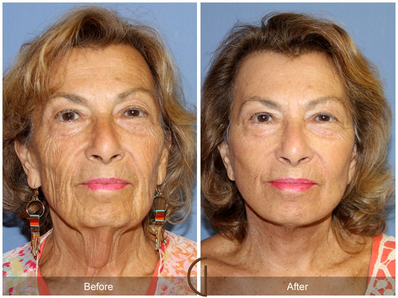 Facelift Cypress CA Image