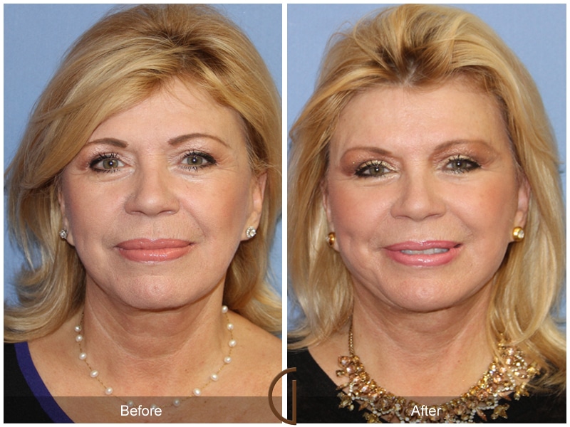 Facelift Huntington Beach CA 118 Image