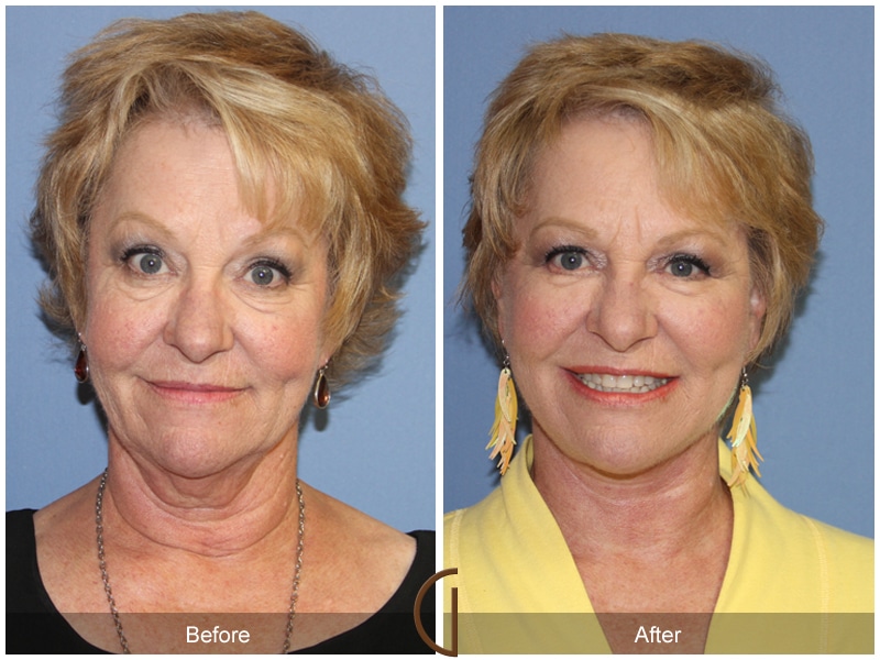 Facelift Brea CA 120 Image