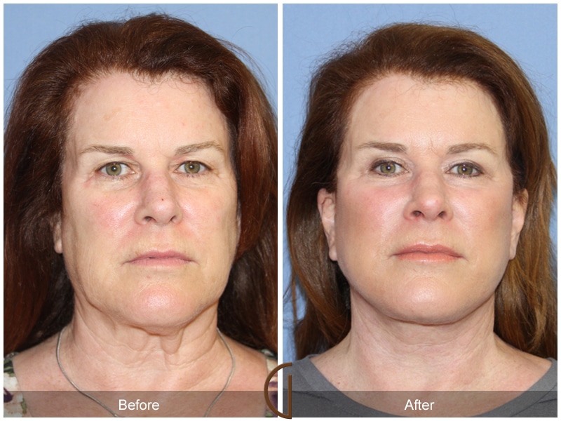 Facelift Placentia CA 121 Image