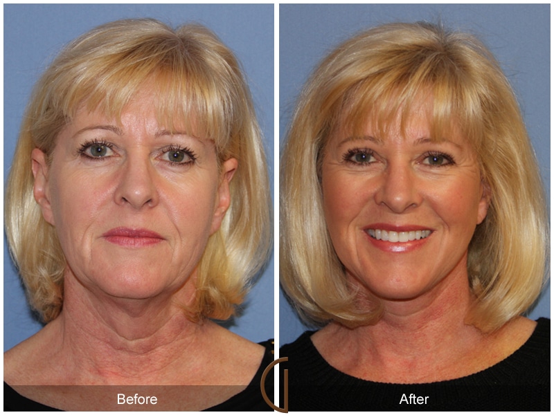 Facelift Garden Grove CA Image