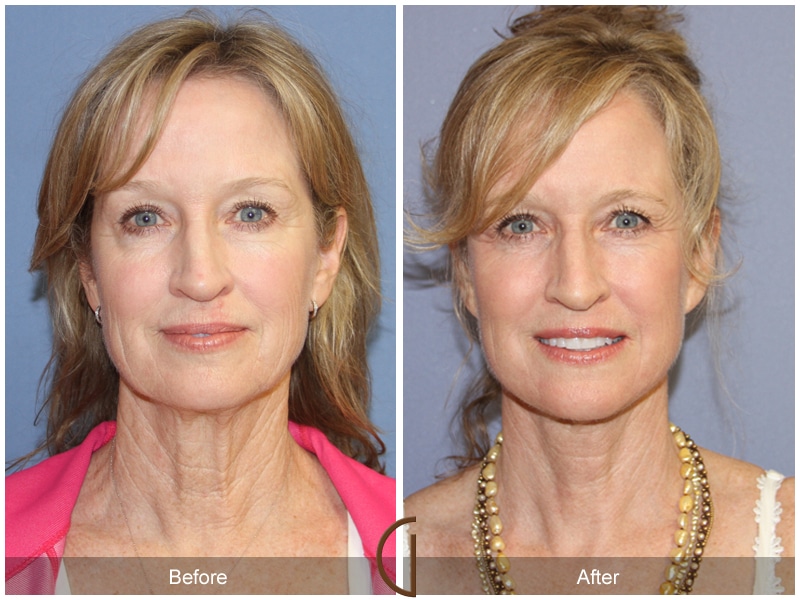 Facelift Beverly Hills Image
