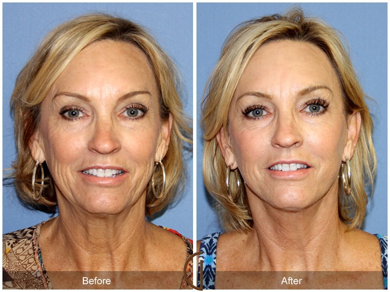 Facelift Santa Ana Image