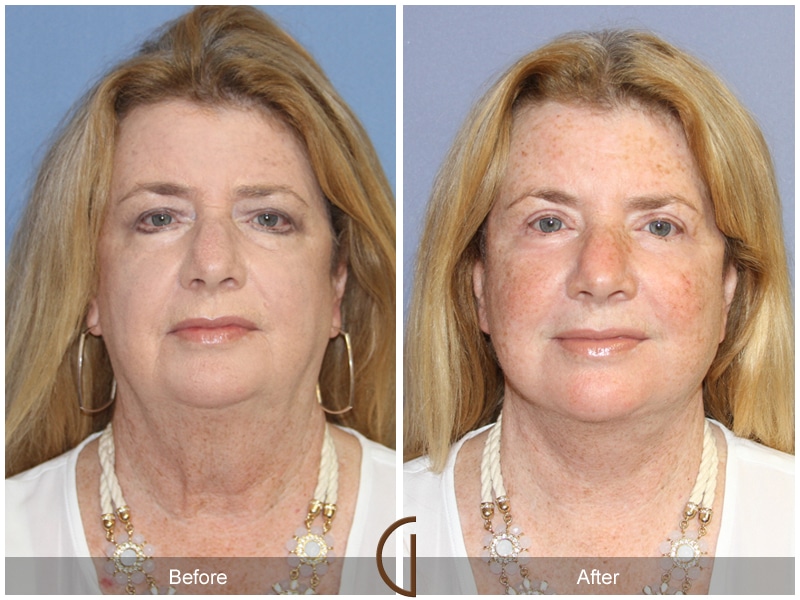 Facelift Anaheim Image
