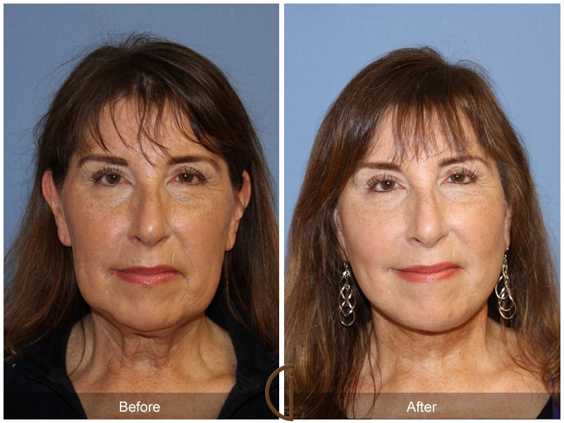 Facelift Laguna Woods CA 141 Image