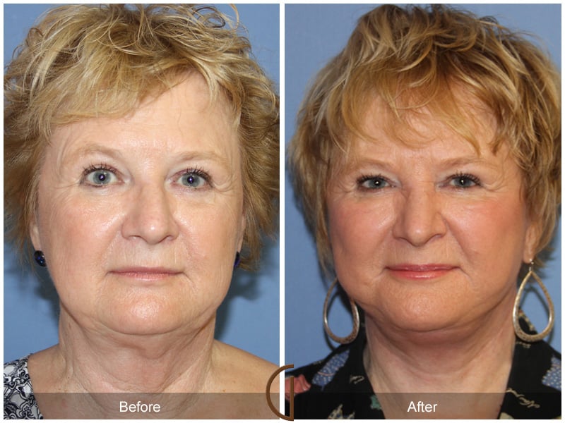 Facelift Hidden Hills CA 142 Image