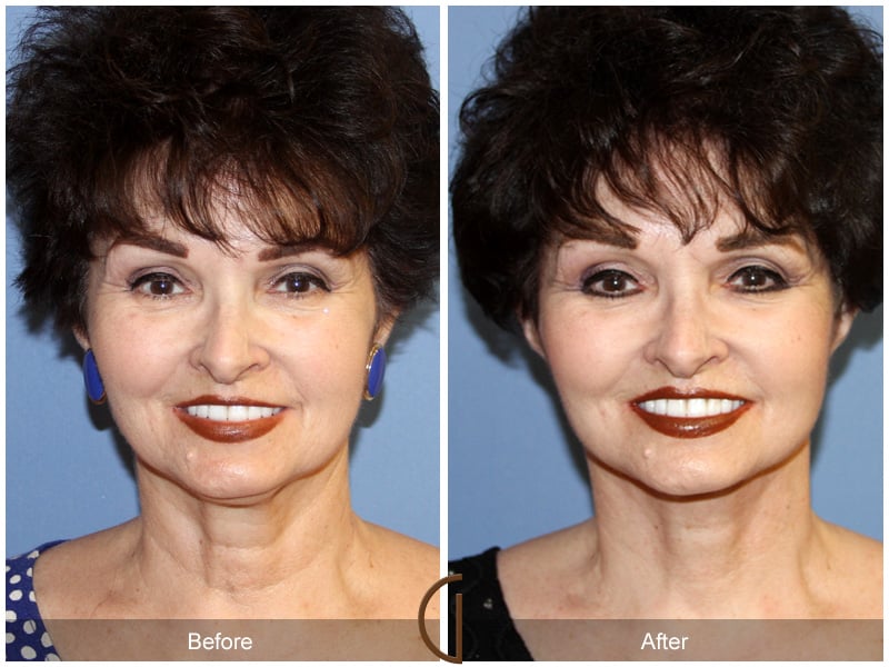 Facelift La Cañada Flintridge CA 145 Image