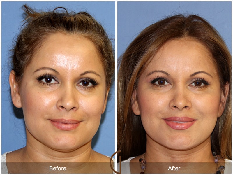 Facelift La Habra Heights CA 157 Image
