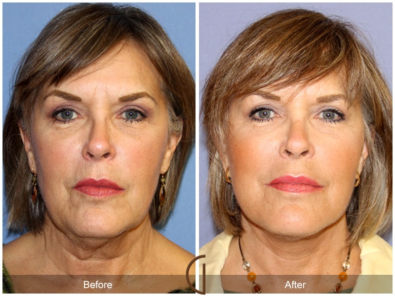 Facelift Eastvale CA 158 Image