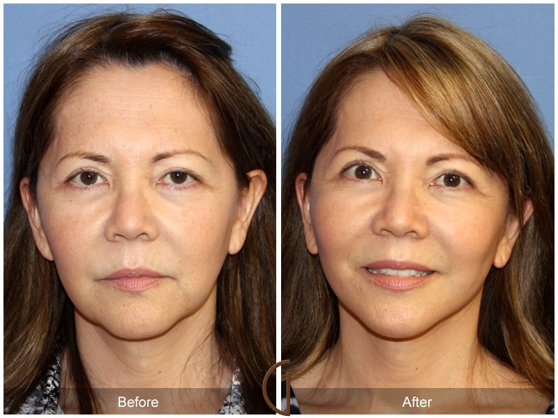 Facelift Jamul CA 159 Image