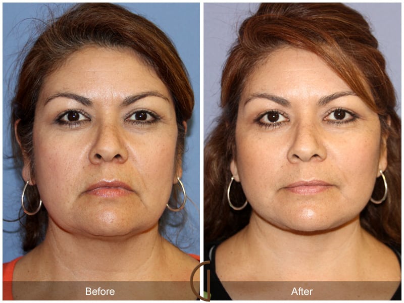 Facelift Castaic CA 160 Image