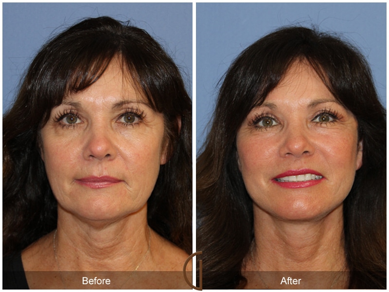 Facelift Rancho Santa Fe CA 166 Image