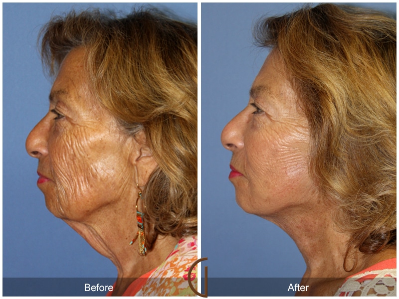 Facelift Cypress CA Image