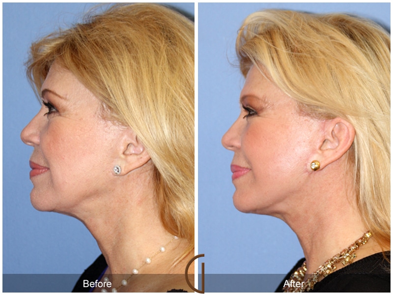 Facelift Huntington Beach CA 118 Image