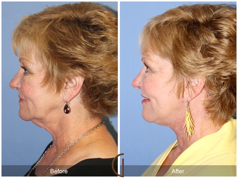 Facelift Brea CA 120 Image