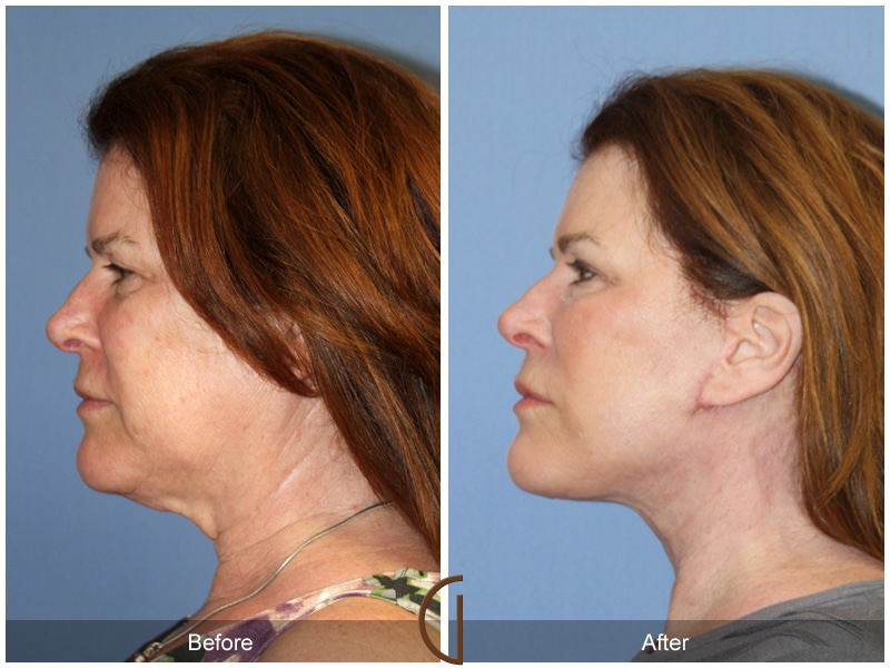 Facelift Placentia CA 121 Image