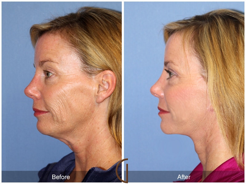 Facelift La Habra CA 132 Image